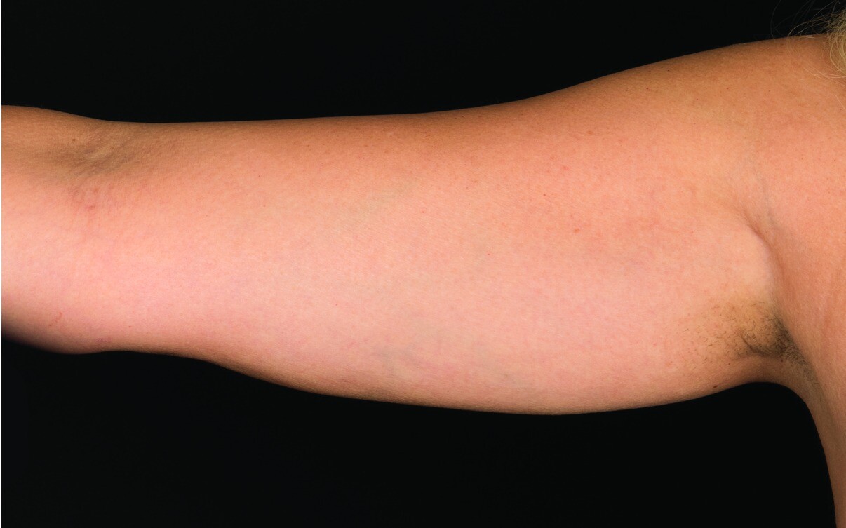 109-Female-Abdomen-DrBowes-Medium.jpg_0002_Before.jpg 109-Female-Abdomen-DrBowes-Medium.jpg_0002_Before.jpg