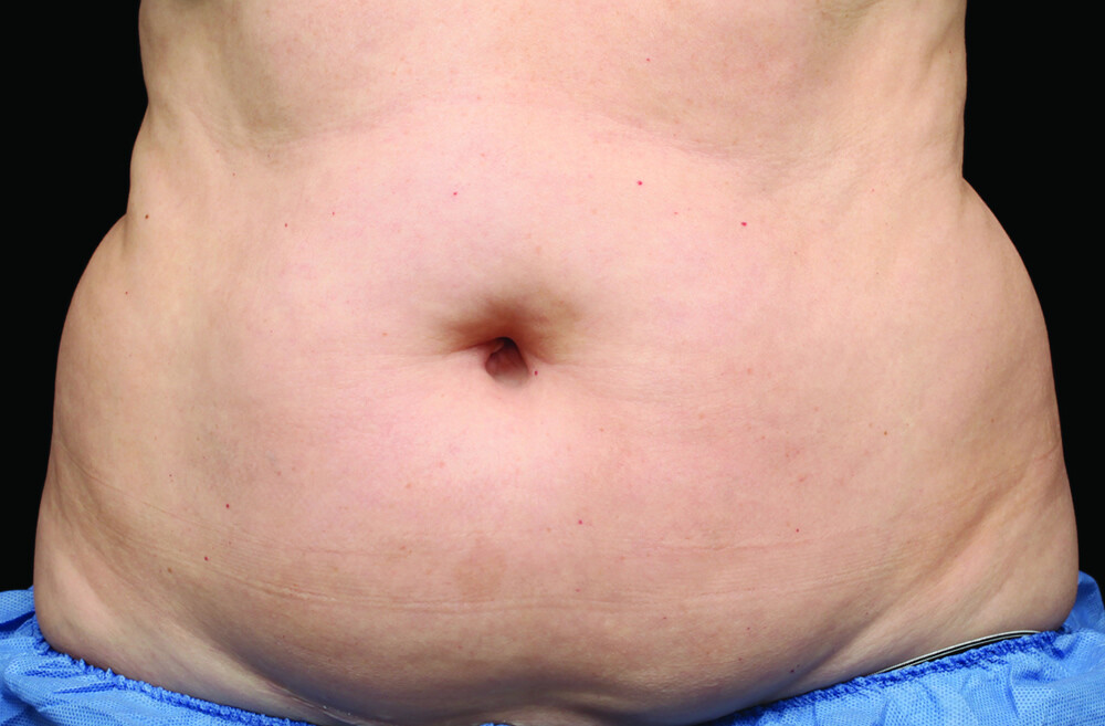 CoolSculpting-belly-before.jpg CoolSculpting-belly-before.jpg