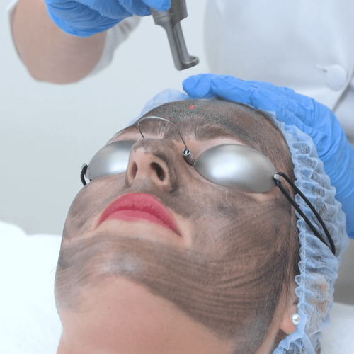laser facials (1)